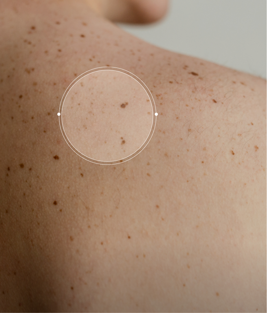 Dos d une femme avec beaucoup de grain de beaute - Maison Abeille Paris 16