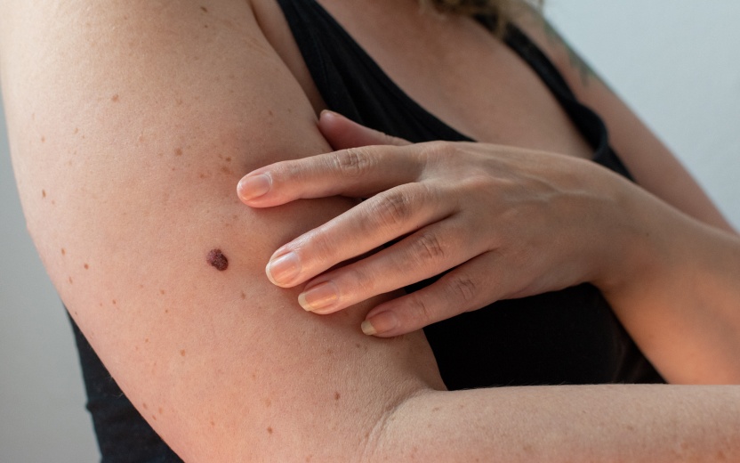 Grain de beaute sur le bras comment prevenir le cancer de la peau - Maison Abeille Paris 16