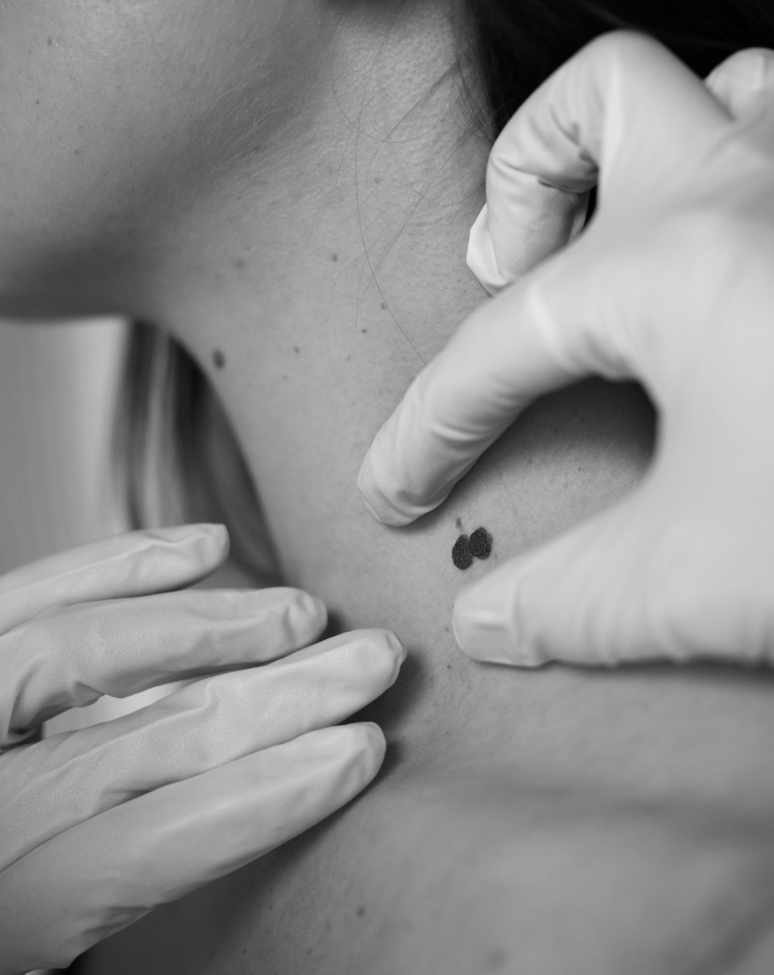 Medecin examinant un grain de beaute suspect sur le cou d une femme | Maison Abeille dermatologique Paris 16